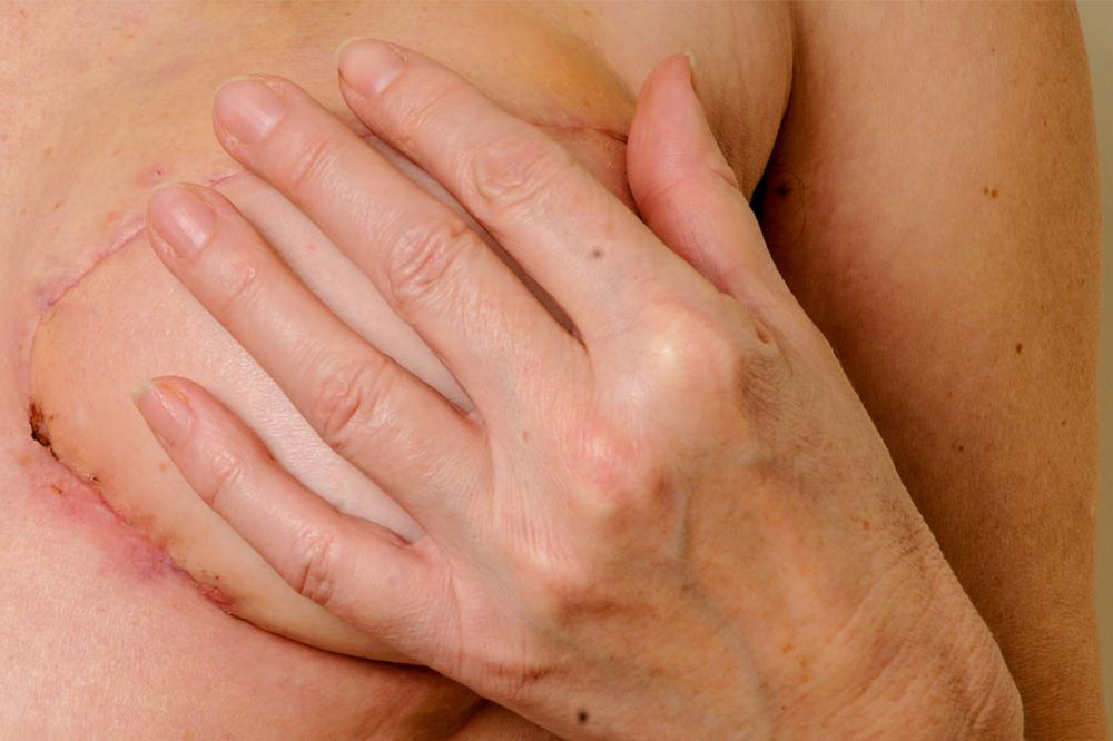 Signs and Symptoms of Breast Cancer