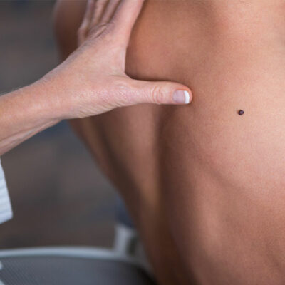 Symptoms, Treatment and Prevention of Melanoma