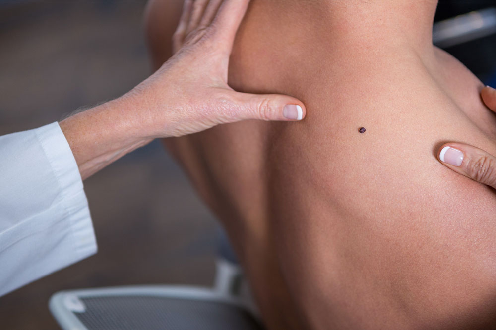 Symptoms, Treatment and Prevention of Melanoma