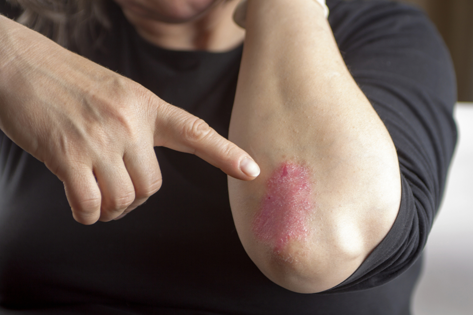 8 Foods to Avoid Plaque Psoriasis and Treatment Options Available